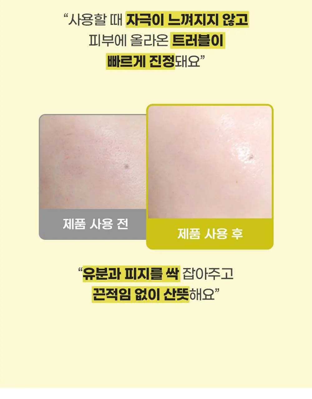 [트러블/과잉피지완화]앰플엔 아크네샷 앰플 30ml 상세페이지 9